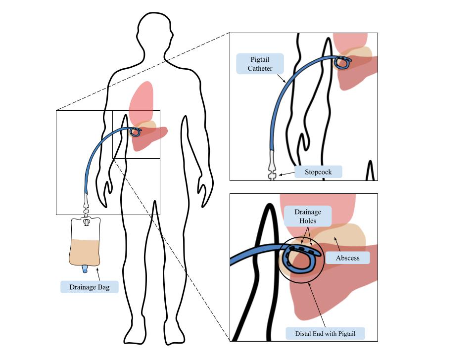 Influo directed flushing catheter concept